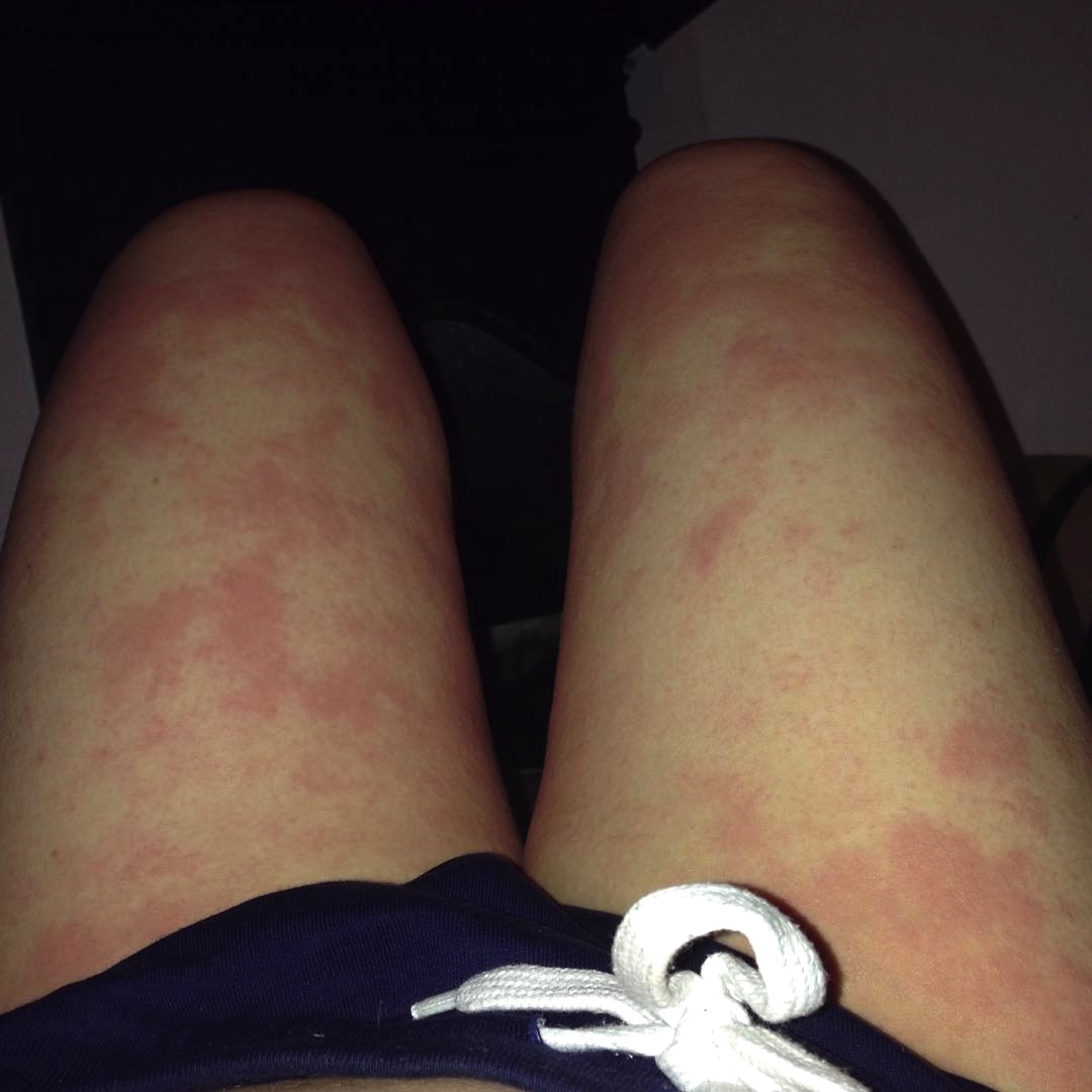 Jock Itch Rash